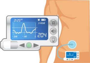 Continuous Glucose Monitoring - The key to improving BG? - Diabetes ...